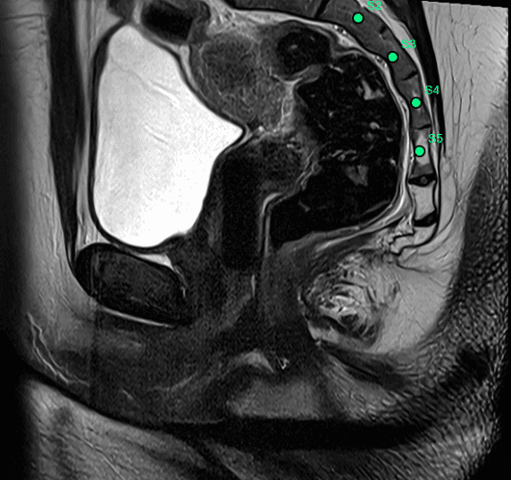 Sagittal MRI • S1 detected